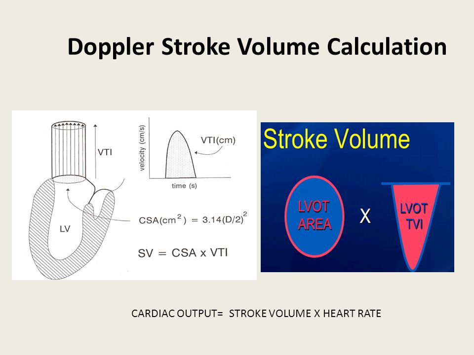 how to calculate cardiac output example