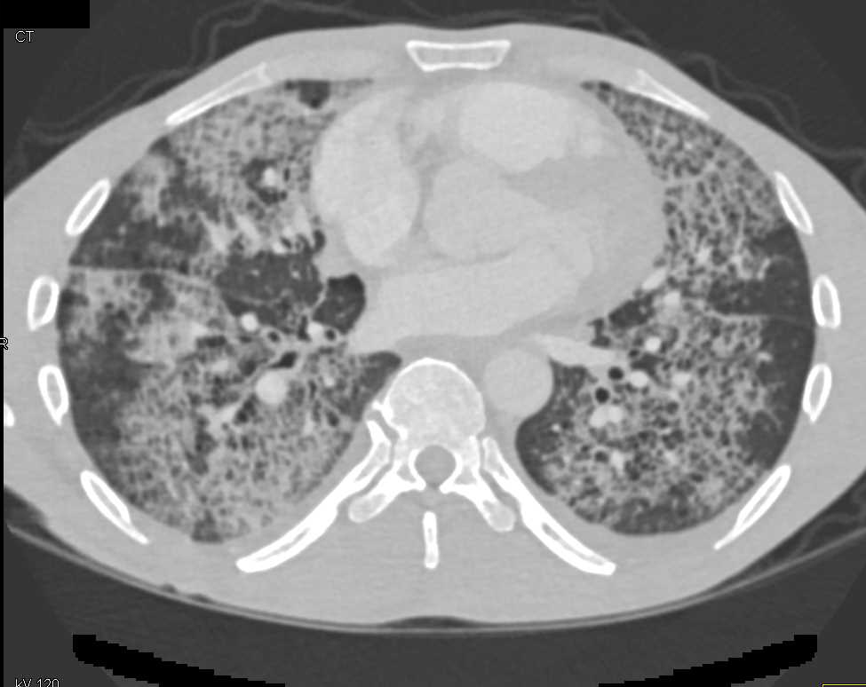 case study about pulmonary oedema example
