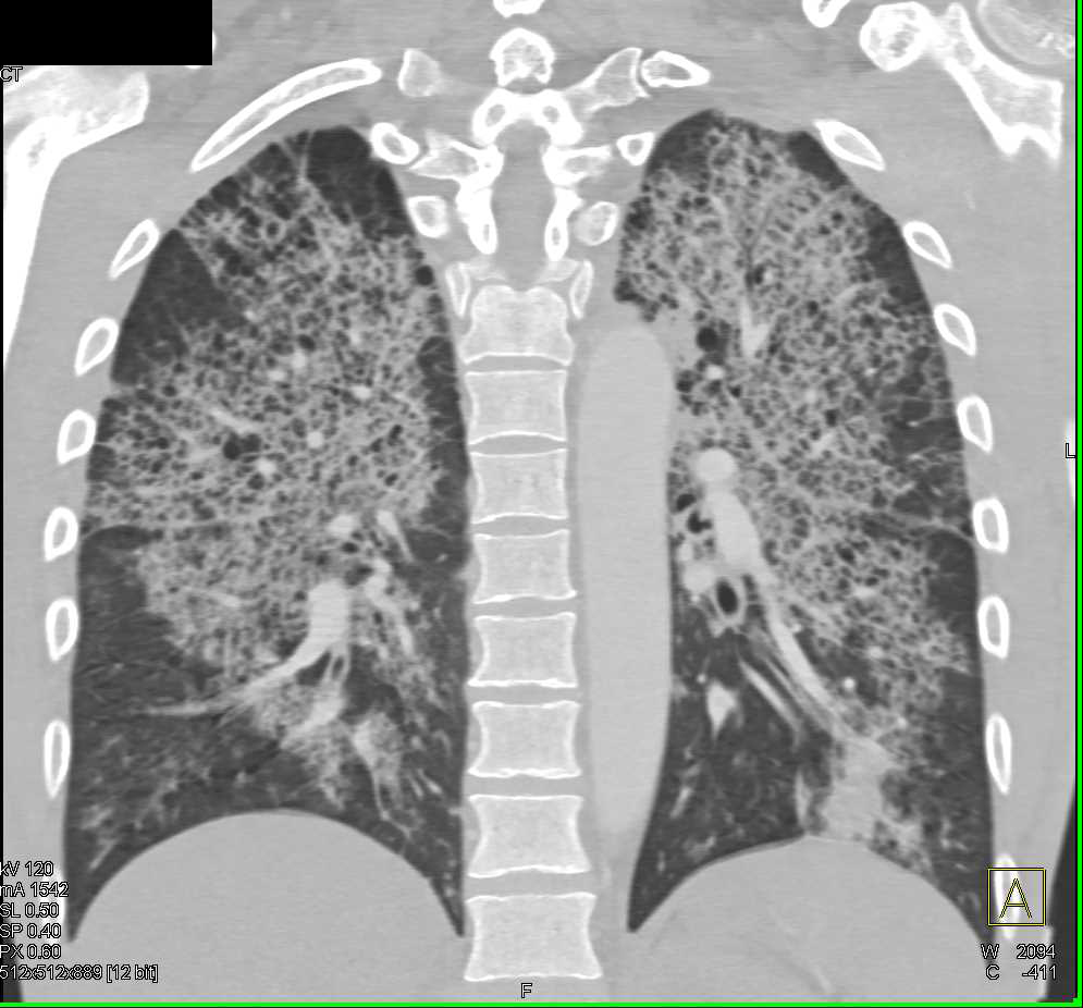case study about pulmonary oedema example